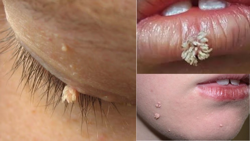 Filiform Warts